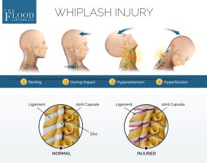 Whiplash Injury FromA Car Accident | Connecticut Injury Attorney